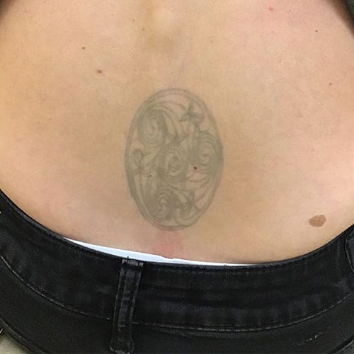 Before Lower Back Tattoo Removal