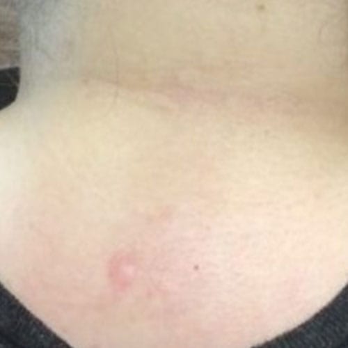 Laser Tattoo Removal Neck After Photo