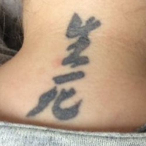 Laser Tattoo Removal Neck Before Photo