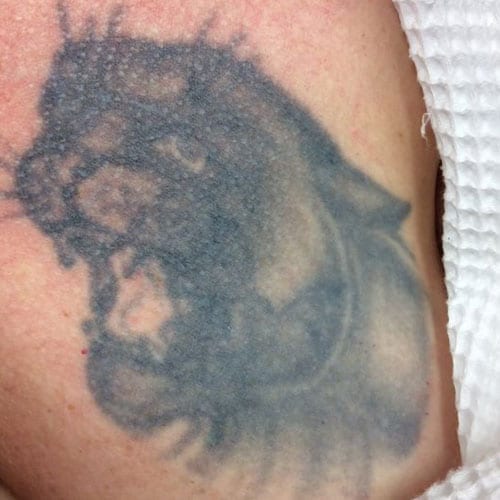 Laser Tattoo Removal Chest Before