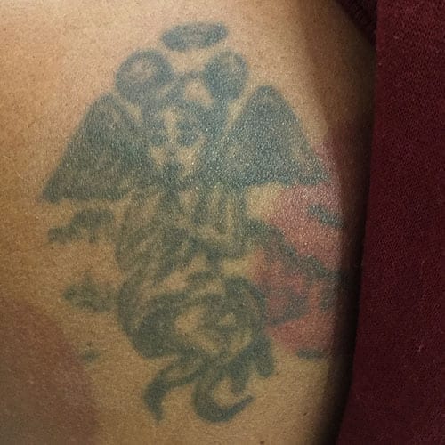 tattoo removal dallas cost