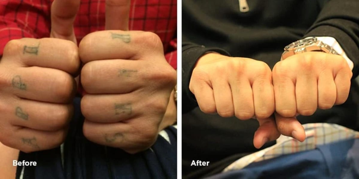 Knuckle Tattoo Removal Results