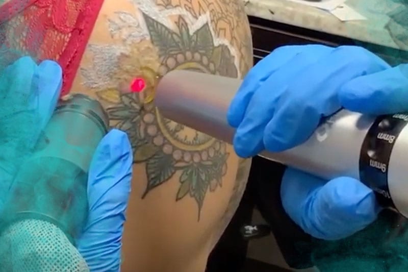 woman shoulder tattoo removed before and after