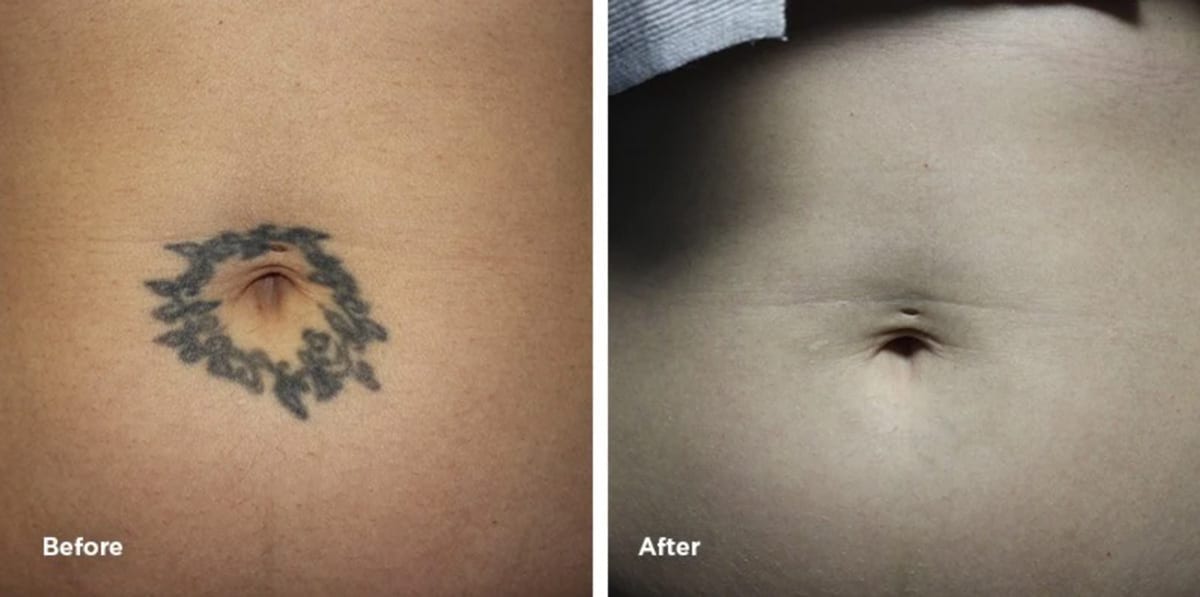 Stomach tattoo removal