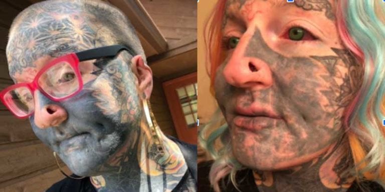 Face Tattoo Removal