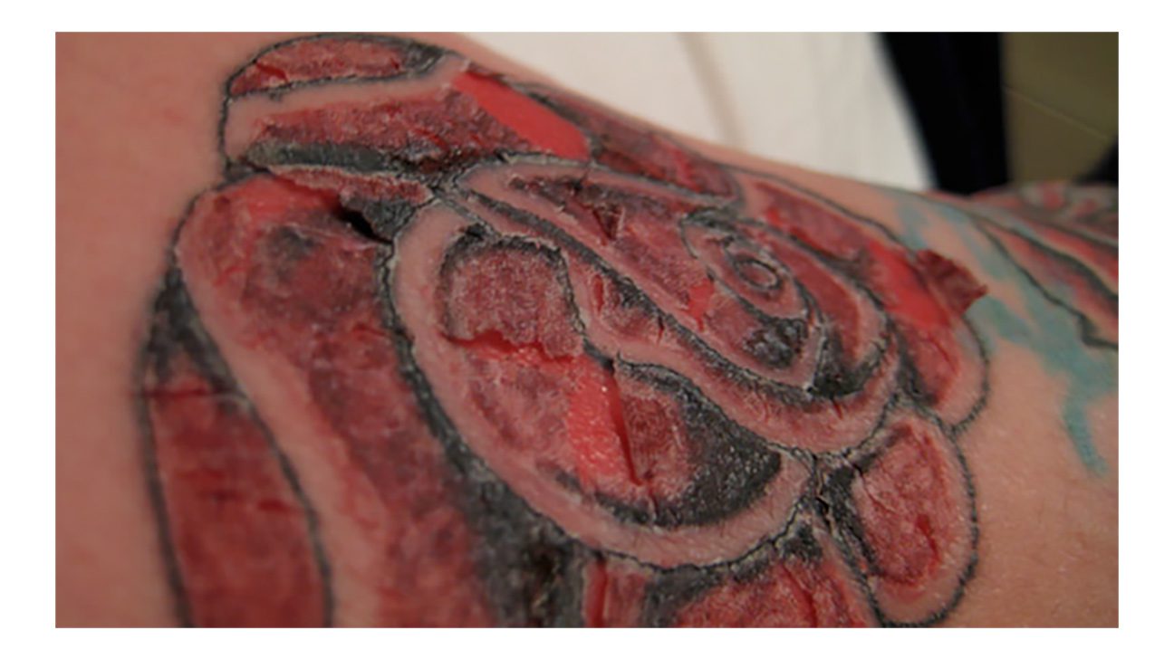 Tattoo Allergy: Can You Be Allergic To Tattoo Ink? | Removery