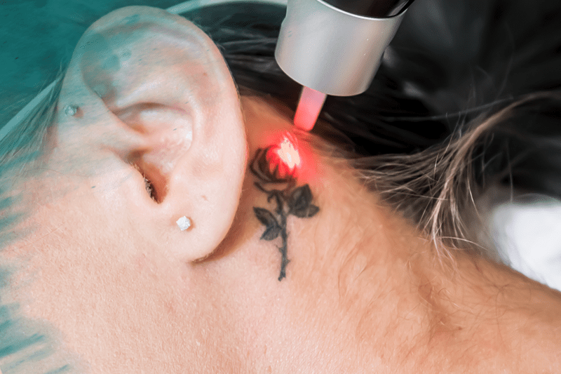 Laser removal of behind the ear rose tattoo
