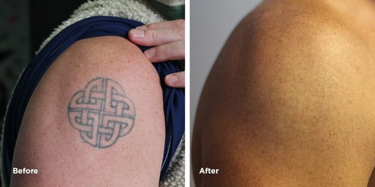shoulder tattoo removal before and after