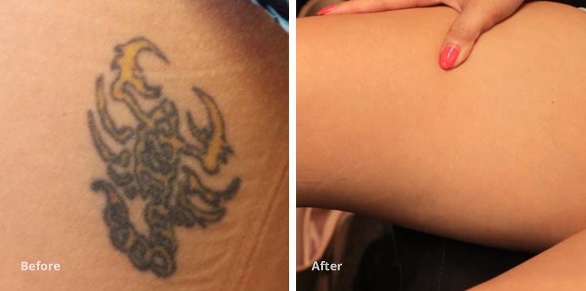 Is Tattoo Removal Safe | Removery