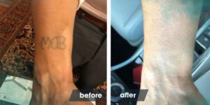 Before and after of Terrance Lewis' tattoo removal