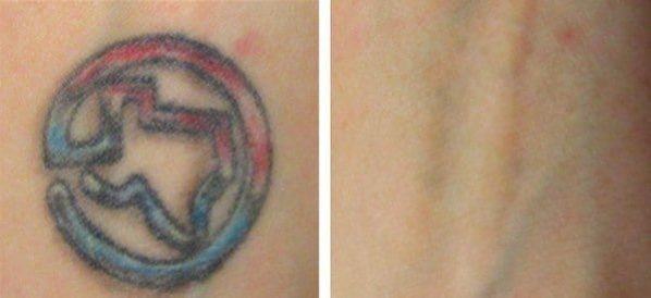 Texas - Tattoo Removal Experts | Removery