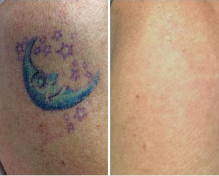 Before and after tattoo removal progress picture, showing final results for removal. On the left you can see a color upper arm tattoo, on the right the tattoo and color is removed.