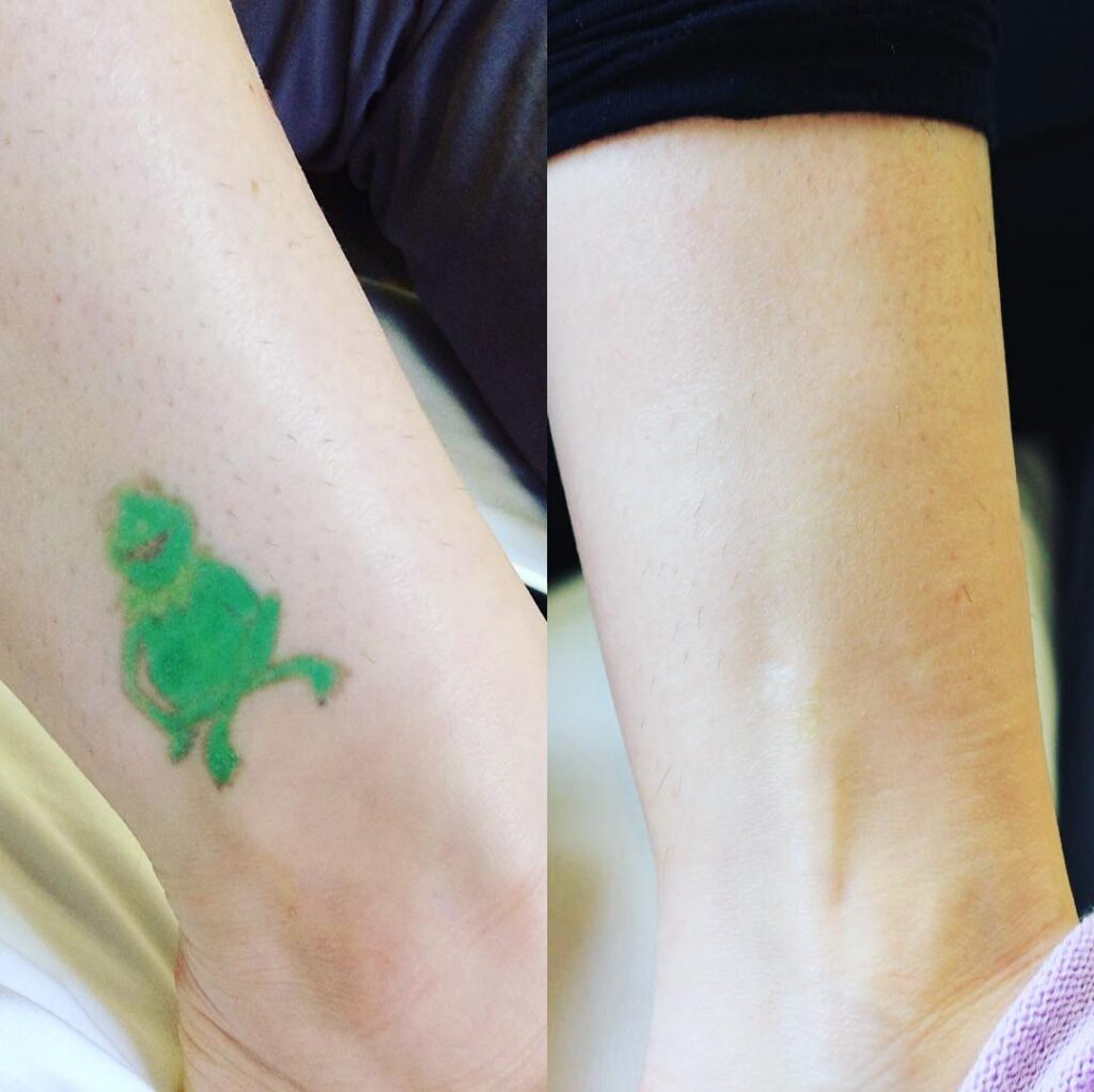 Vol 1: Top 10 Before & After Tattoo Removal Results | Removery