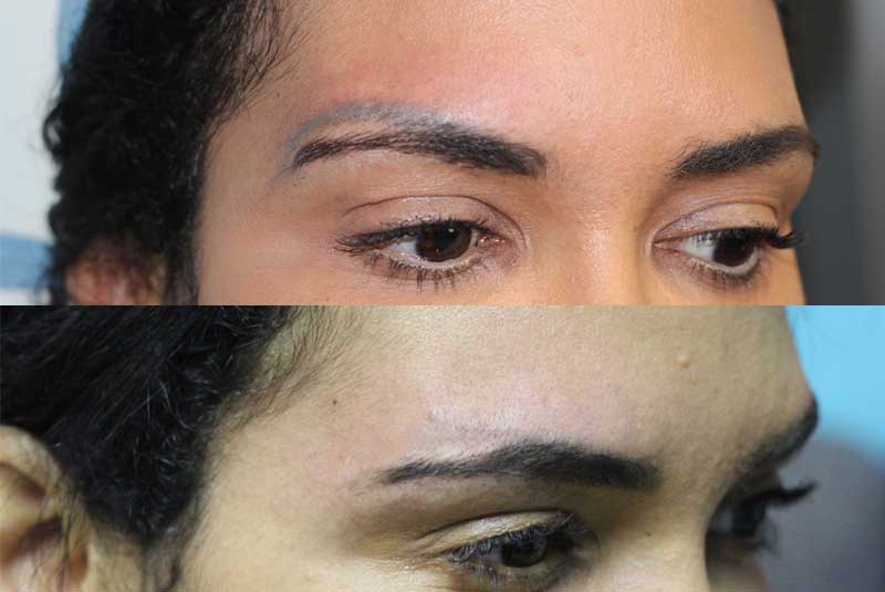 Permanent Makeup Eyebrow Tattoo Removal Service