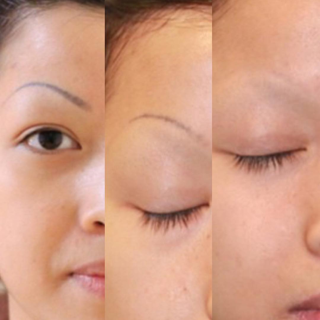 Cosmetic and Eyebrow Tattoo Removal Removery