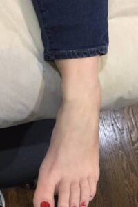 after removal
