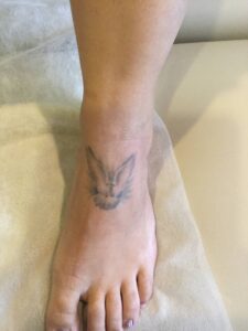 before removal