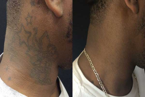 Dark Skin Type Neck Tattoo Before and After