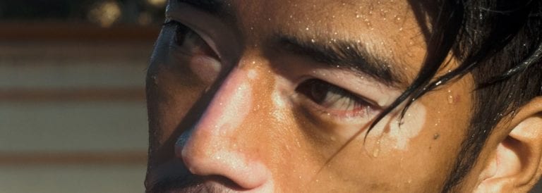 Tattoo Removal Hypopigmentation and Hyperpigmentation