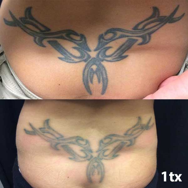 Lower back tattoo removal
