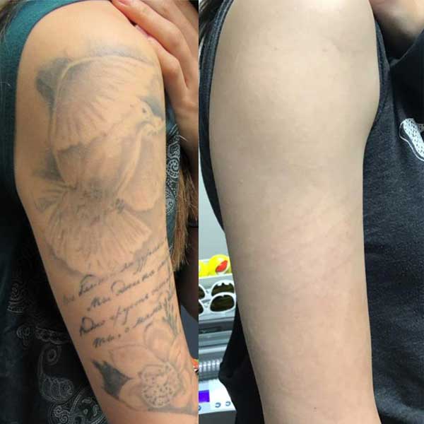 Removery  Formerly GO Tattoo Removal  Absolutely massive fading on this  half sleeve tattoo thats had a total of 7 treatments Every tattoo will  have different results we post a wide