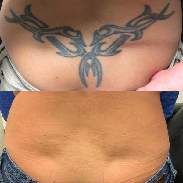 Successful Tattoo Removal Result Before & After Showing the top image with a large tattoo. Then after many tattoo removal sessions and tons of progress, the tattoo is removed in the bottom image. 