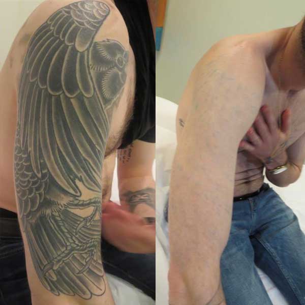 Full and Half Sleeve Tattoo Removal | Removery