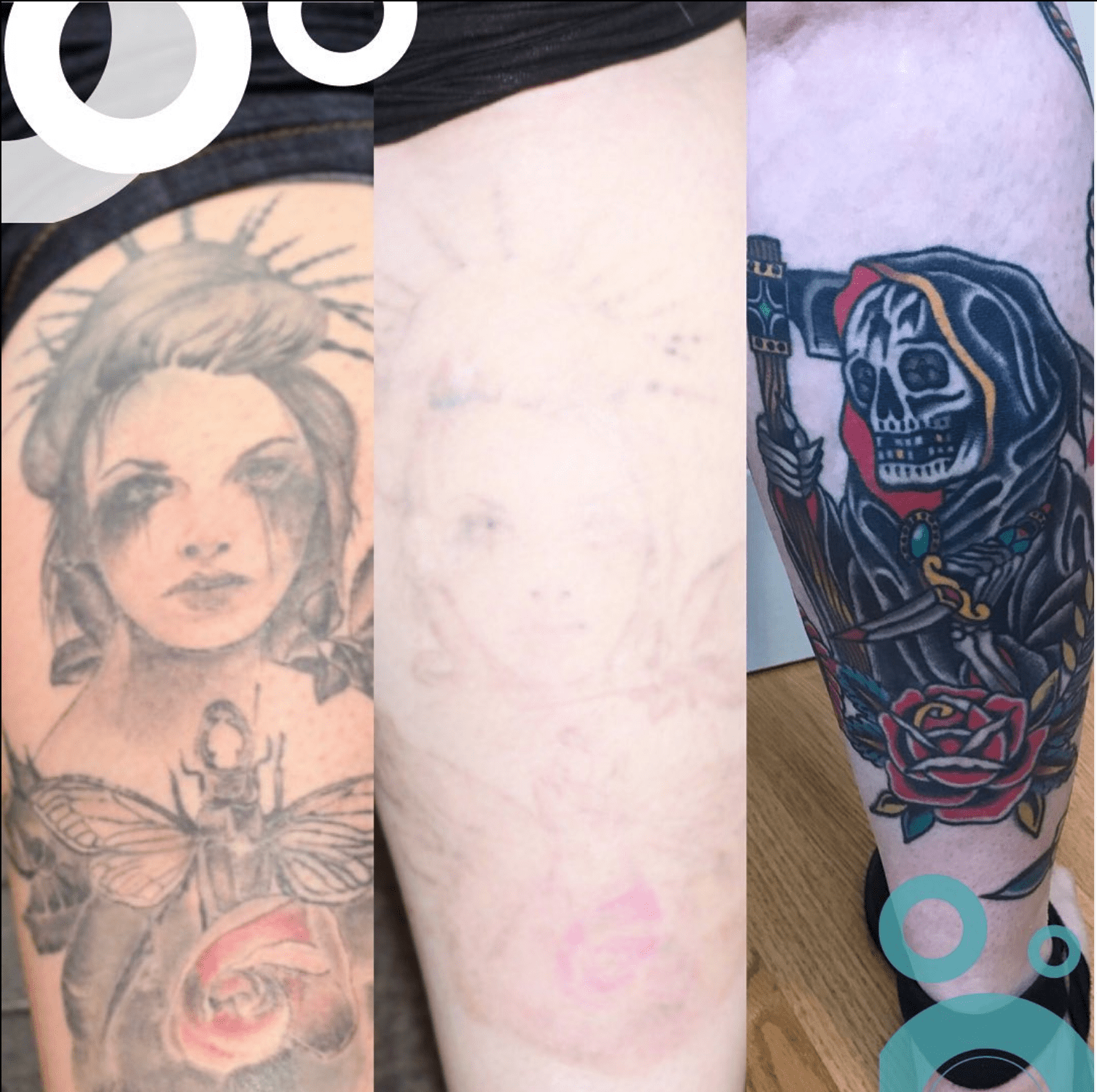 When Can You Tattoo Over Laser Tattoo Removal? | Removery