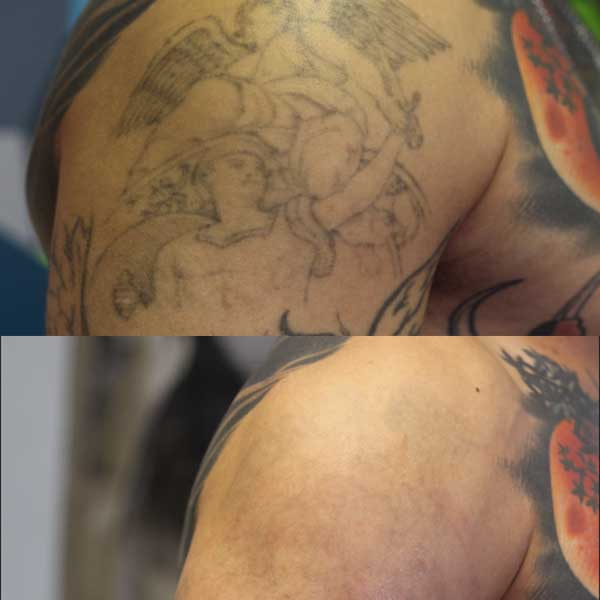 Full and Half Sleeve Tattoo Removal Removery