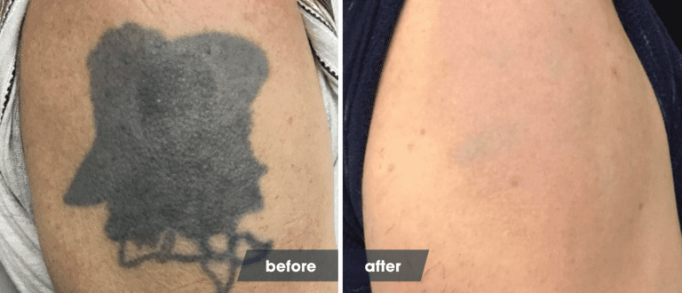 The Laser Tattoo Removal Healing Process Removery