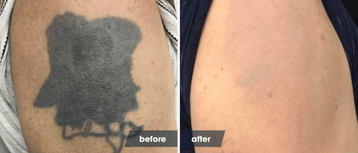 The Laser Tattoo Removal Healing Process | Removery