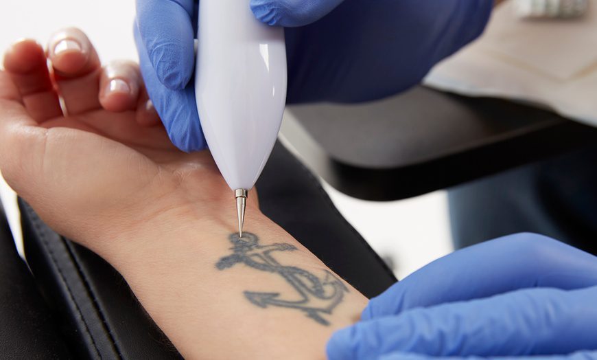 Saline Tattoo Removal vs Laser Tattoo Removal | Removery