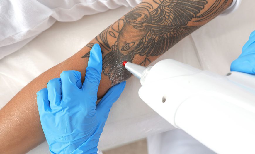 Saline Tattoo Removal vs Laser Tattoo Removal Removery