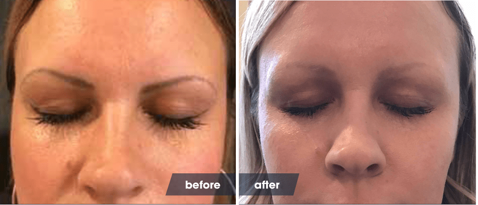 microblading removal before and after