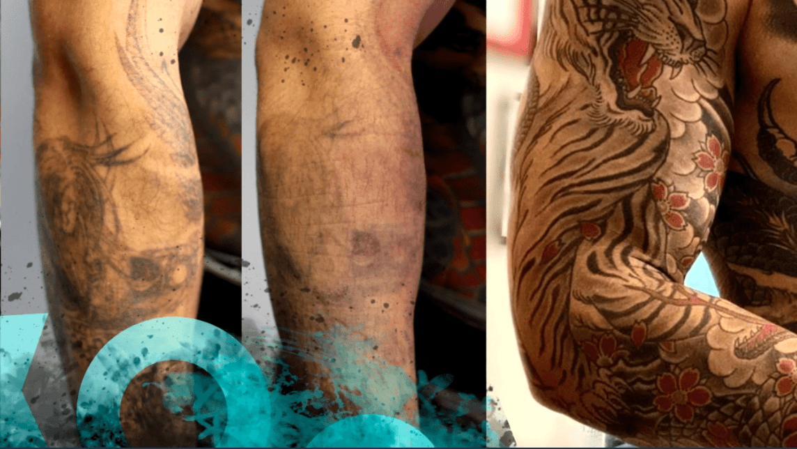 Tattoo lightening • LASER ÄSTHETIK. Laserbehandlungen für Tattooentfernung  & Haarentfernung