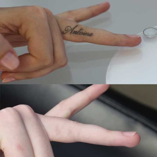 Antoine before and after tattoo removal from finger