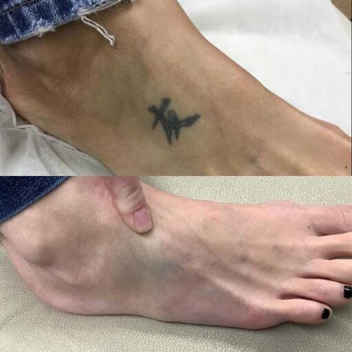 Japanese kanji tattoo removal