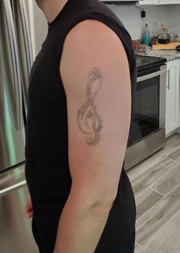 Client after laser tattoo removal