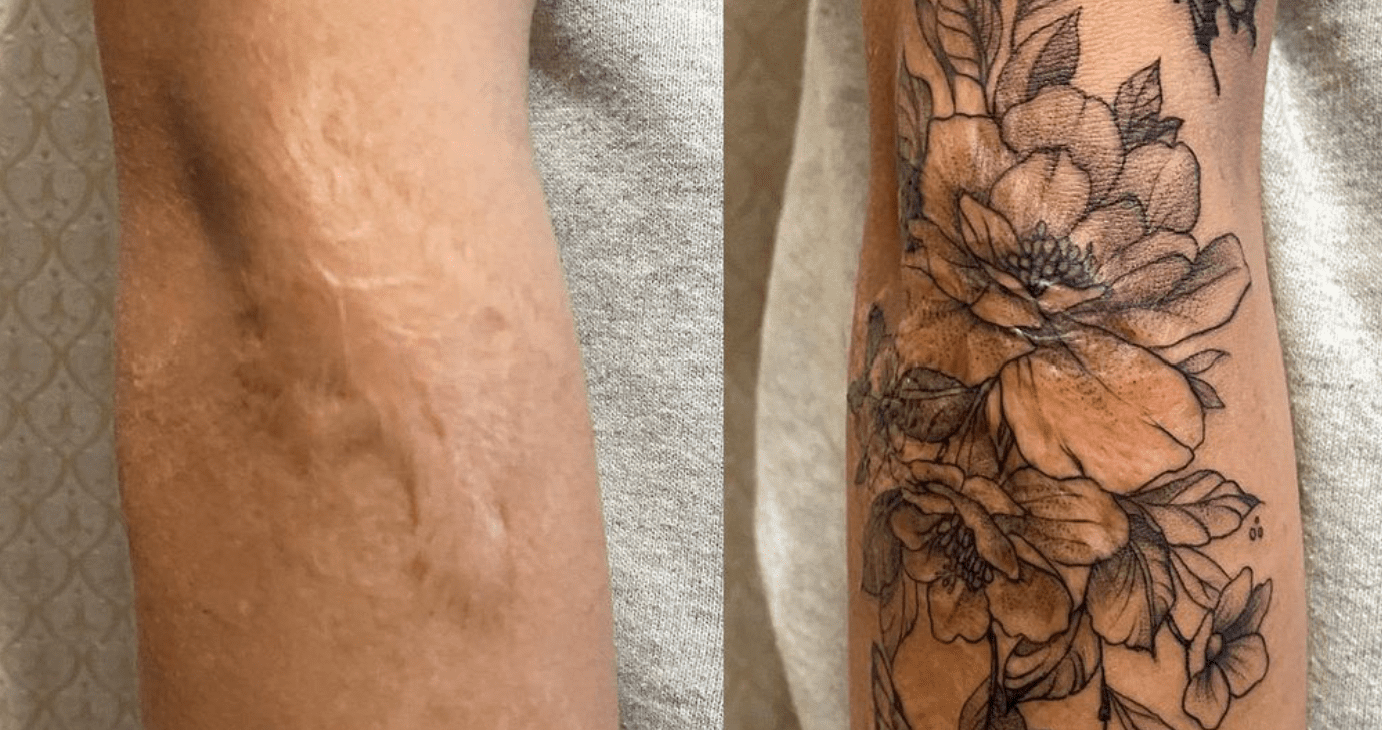 Can tattoos cover scars effectively