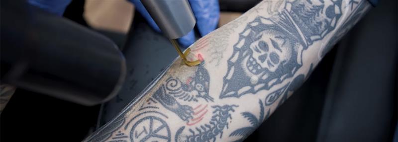 Tattoo Removal Progress and Results: What to Expect | Removery