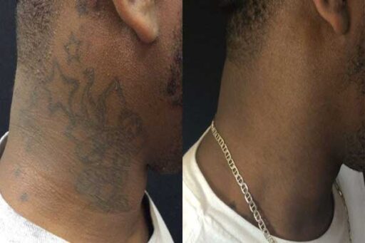 Dark Skin Type Neck Tattoo Before and After