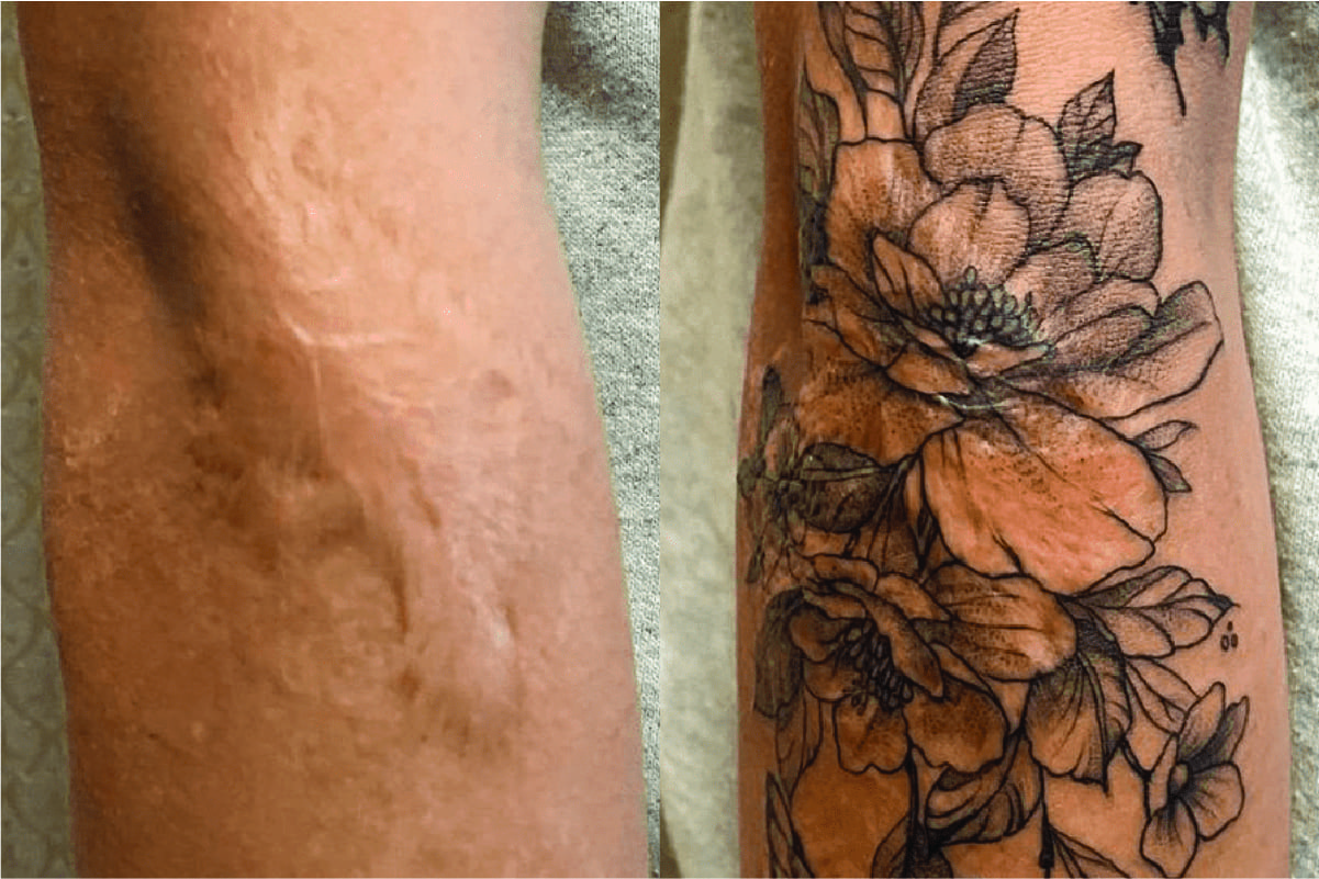 Using tattoos to cover scars