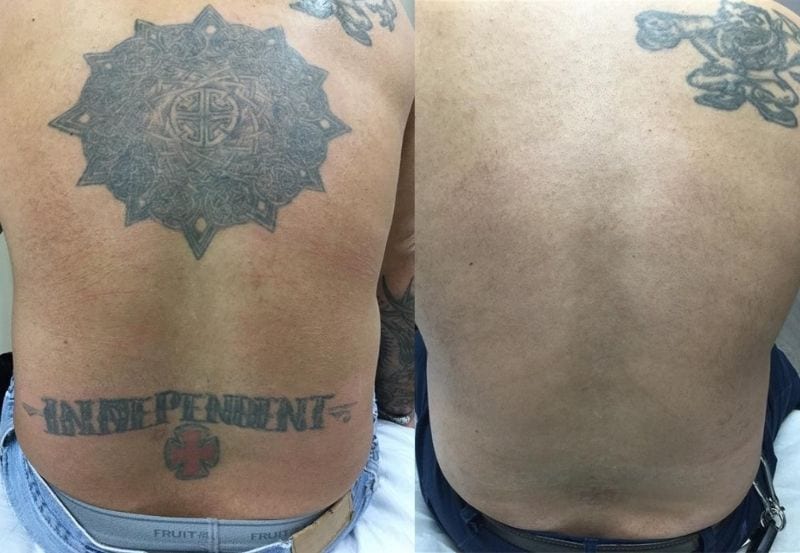 Laser Tattoo Removal Before and After Removery