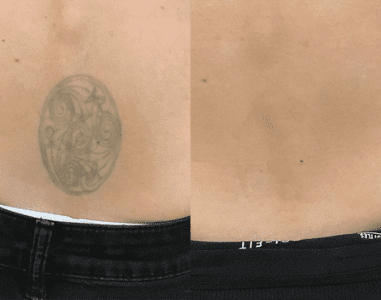 Back Tattoo Removal Before and After