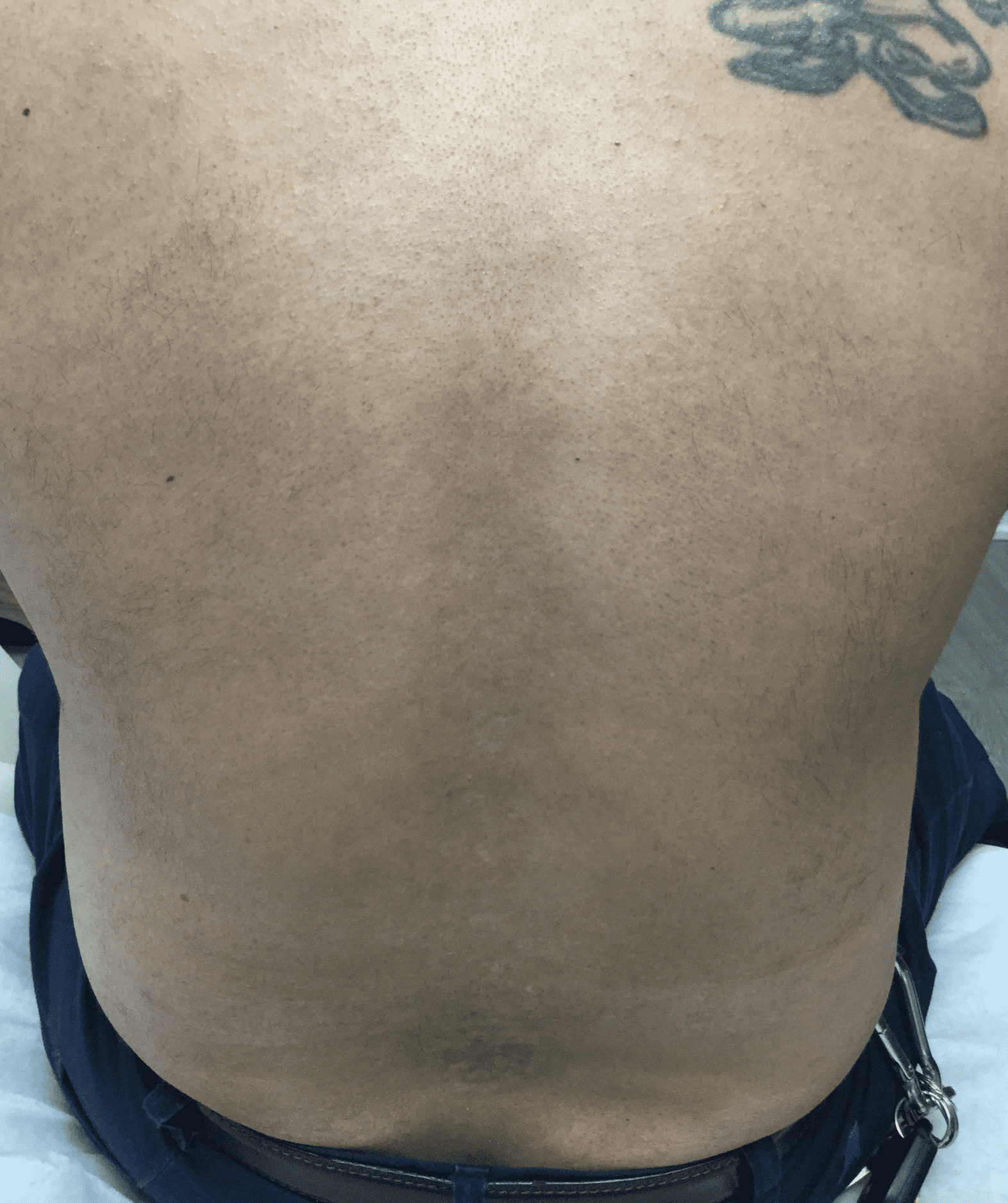Vol 1: Top 10 Before & After Tattoo Removal Results | Removery