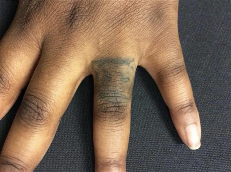 Finger Tattoo Removal - wide 3