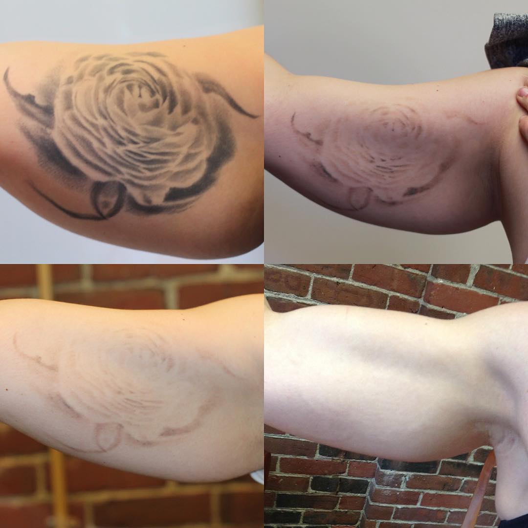 Laser Tattoo Removal | Real People, True Results - YouTube