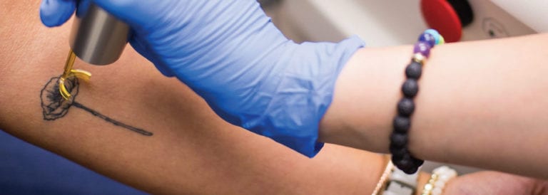 Guía para evaluar las máquinas láser de eliminación de tatuajes