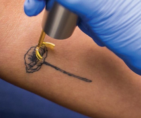 Guide to Evaluating Laser Tattoo Removal Machines