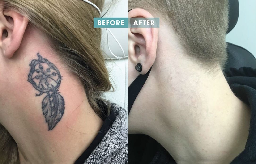 Results of Laser Tattoo Removal | Removery